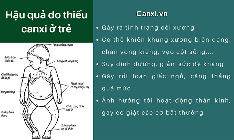 Hậu quả của trẻ bị thiếu canxi kéo dài